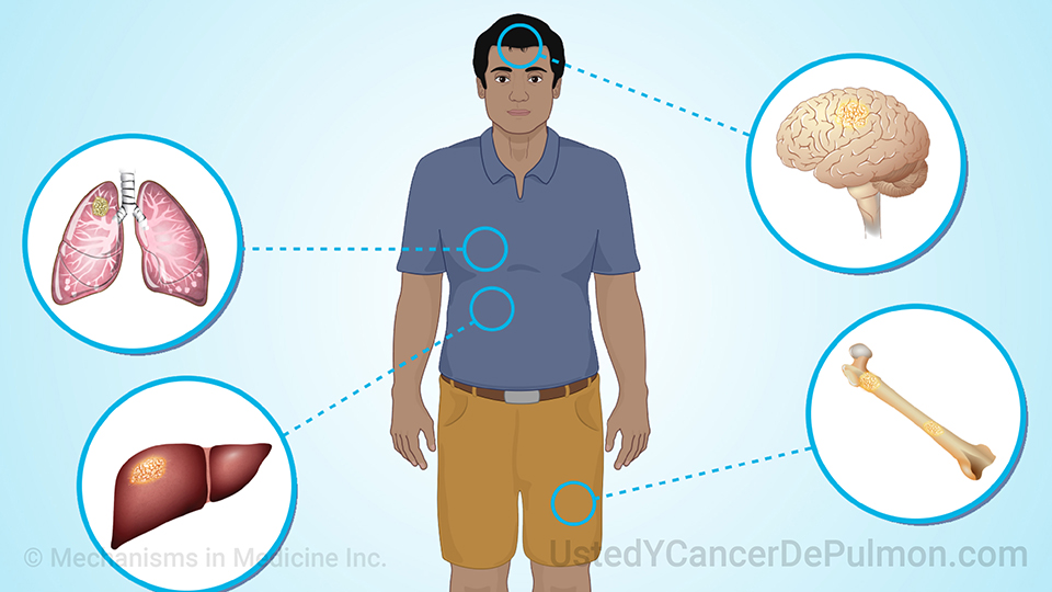 Comprender el cáncer de pulmón de células pequeñas