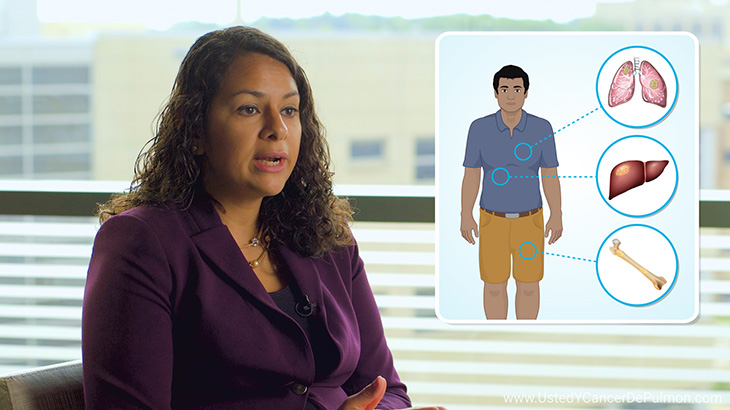 ¿Qué significa que un paciente tiene “cáncer pulmonar metastásico”?