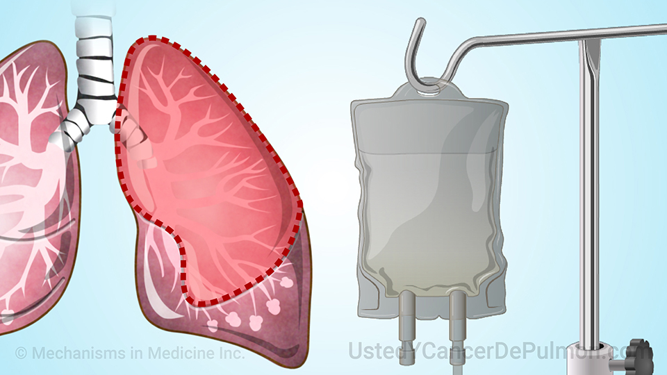 Animación - Tratamiento y manejo del cáncer de pulmón de células pequeñas